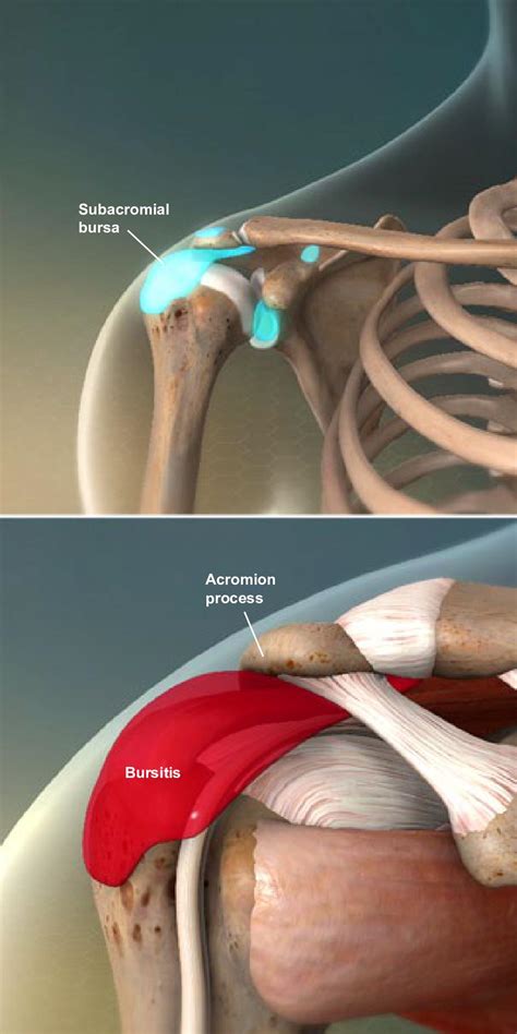 Subacromial Bursitis Exercises