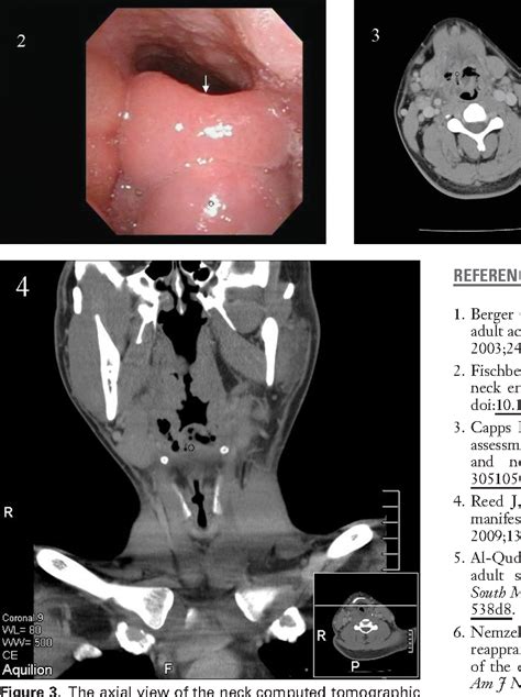 Figure 3 from Acute epiglottitis complicating an emphysematous abscess ...