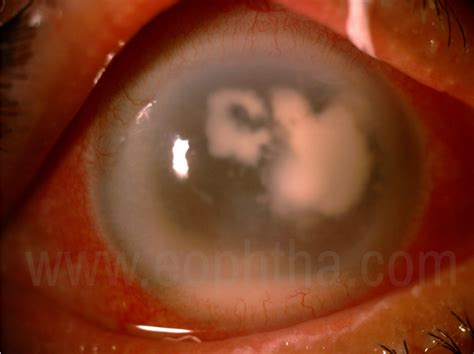 Fungal Corneal Ulcer