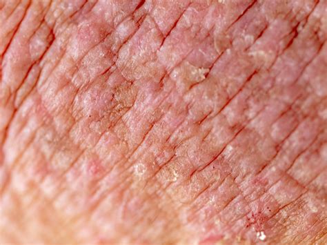 Eczema Skin Rashes That Look Like