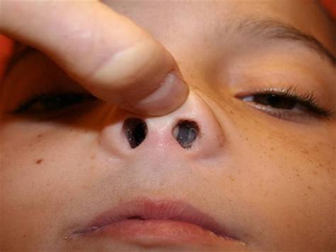 Nasal Polyps | France| PDF | PPT| Case Reports | Symptoms | Treatment