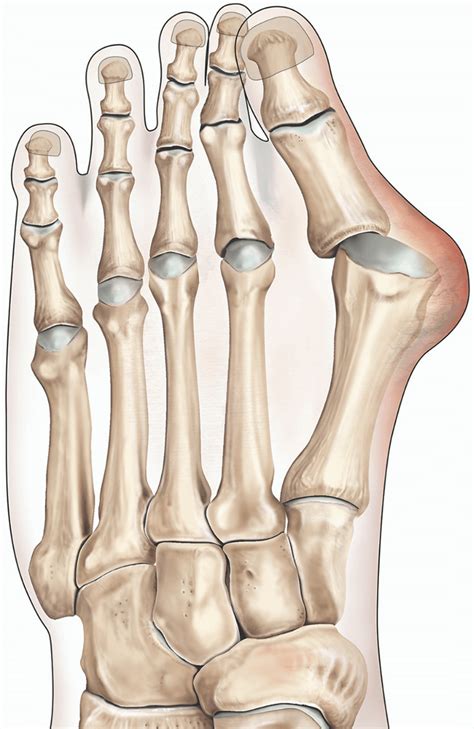 Bunion surgery | healthdirect