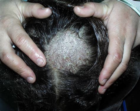 Tinea capitis scalp, causes, symptoms, diagnosis & tinea capitis treatment