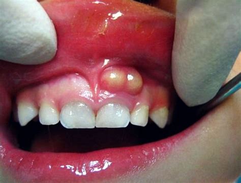 How Can You Cope with a Tooth Abscess?