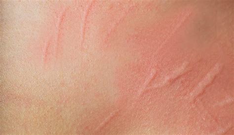 Dermatographia Unveiled: Causes, Symptoms, and How to Manage It