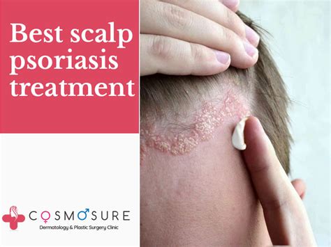 Best Scalp Psoriasis Treatment | Cosmosure Clinic