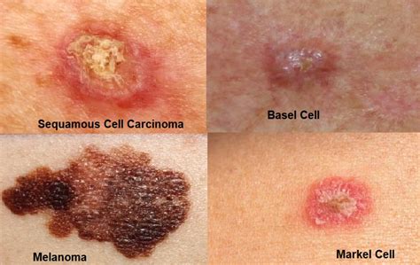 Skin Cancer Types | Most Common Skin Cancer | SunskinClinic