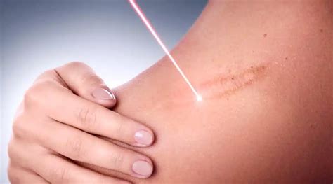 Is Laser Keloid Scar Removal Ideal For You? - 1Aesthetics, Medical ...