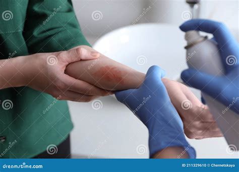 Applying Burn Spray Onto Injured Skin, Closeup Stock Photo - Image of ...