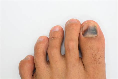 Details more than 137 nail cancer causes super hot - noithatsi.vn