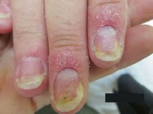 Nail psoriasis causes, symptoms, diagnosis, treatment & prognosis