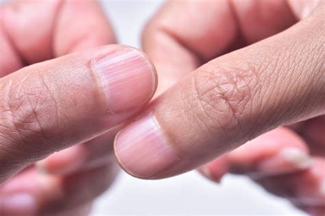 What Causes Ridges in Fingernails | Daily Dose