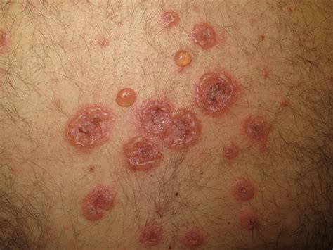 Diagnosing, treating vesiculobullous dermatoses