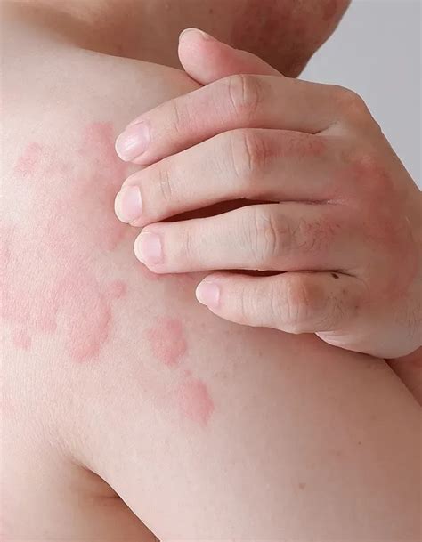 Hives for Tampa and Brandon, FL | Allergy, Asthma, & Immunology ...