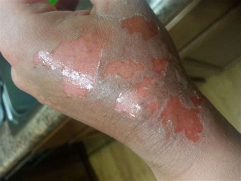 Second-Degree Burns: Pictures, Treatment, Healing Stages