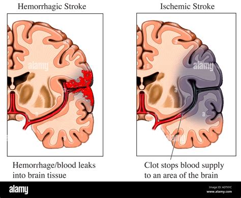 Acute cerebral infarction hi-res stock photography and images - Alamy