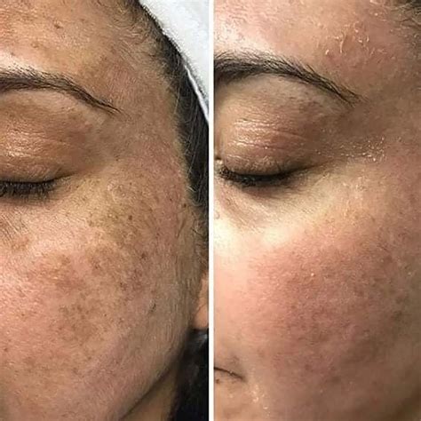 Perfect Image Lactic Acid Peel