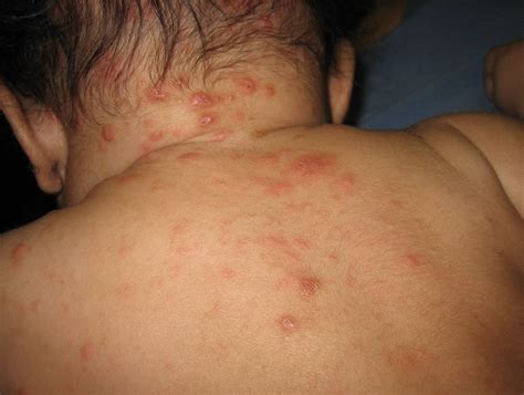 Scabies Rash On Stomach