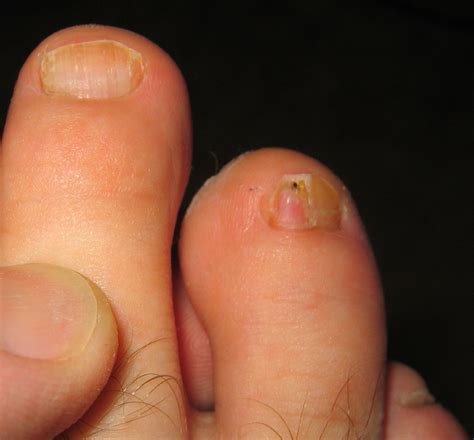 What Causes Fungal Nail Infection In Toes at Harold Curcio blog