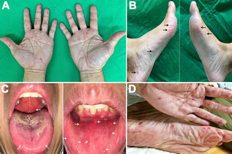 Hand Foot And Mouth Disease In Adults