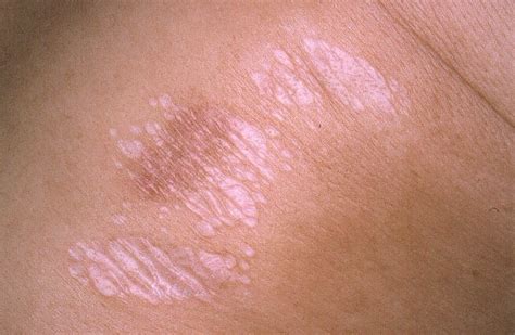 Lichen sclerosus - Causes, Symptoms, Treatment, Diagnosis and Complications