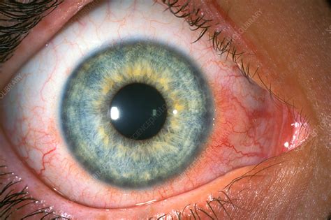 Phlyctenular keratoconjunctivitis - Stock Image - C034/5808 - Science ...