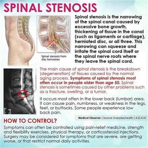 Helpful Scoliosis Stretching Techniques For Sport Cars #SportCars ...