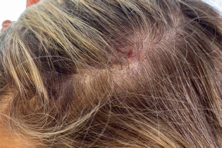 Recurring Scab On Scalp In The Same Spot: Causes, Prevention, Treatment