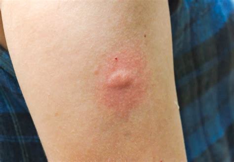 Mosquito Bites Pictures Allergic Reaction