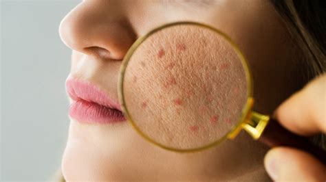 Acne: A Common Skin Condition - Health Channel