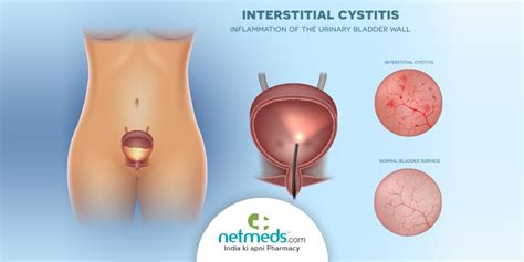 Interstitial Cystitis/Bladder Pain Syndrome: Causes, Symptoms And Treatment