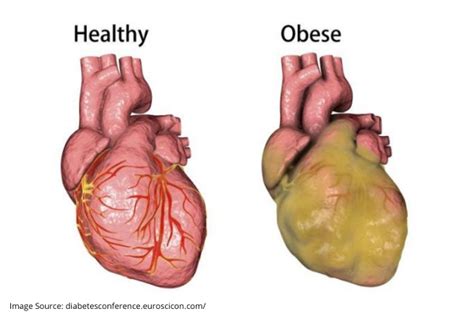 Is Heart Disease Related To Obesity?