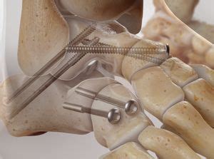 OSS Health | Triple Arthrodesis