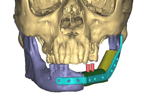 Facial & Oral Cancer Surgery - Medical Orofacial Surgery