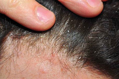 Scalp Psoriasis – Diagnosis and Treatments