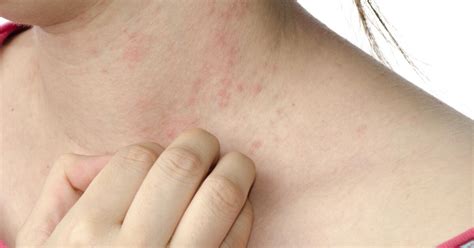 What Causes Hives? | Hives Causes in Children & Adults