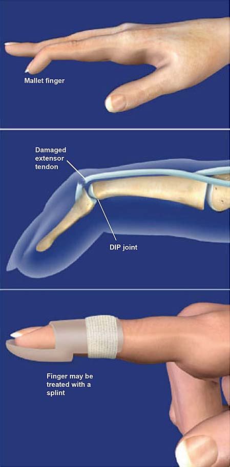 Mallet Finger | Central Coast Orthopedic Medical Group