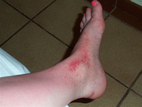 heat rash on foot pictures - pictures, photos