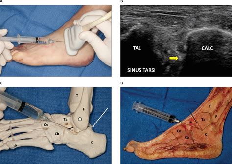 [PDF] Sonographically guided posterior subtalar joint injections via ...