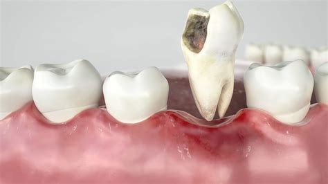 Tooth Extraction Done The Easy Way | Houston Dentists | FMS Dental