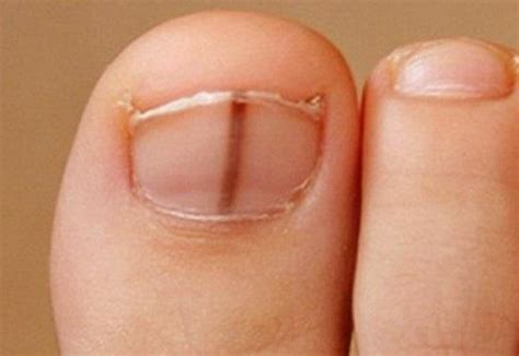 Why Do I Have A Vertical Line On My Toenail - Design Talk