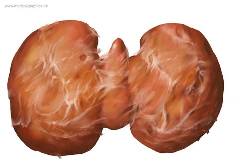 Riedel Struma / Riedel- thyroiditis