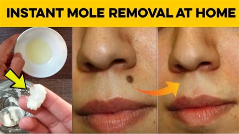 How To Remove Moles On Skin At Home - HOWTORMEOV