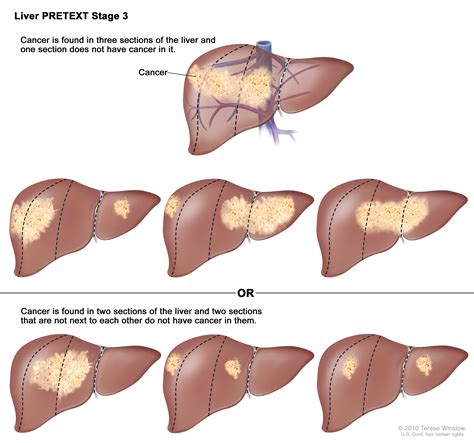 Liver Cancer Stages | MedicineBTG.com