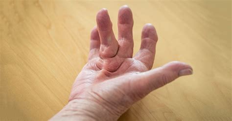 Understanding Dupuytren’s Contractures - Brandon P. Donnelly, MD