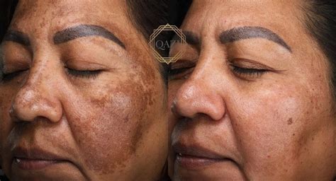 Hydrocortisone for Melasma: Does It Really Work?