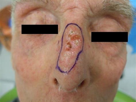 Basal Cell Cancer of the nose - Dr Vindy Ghura Dermatologist Manchester