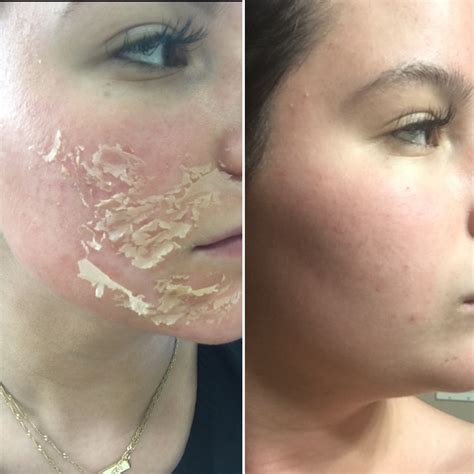 List 90+ Pictures Chemical Peels Before And After Pictures Stunning