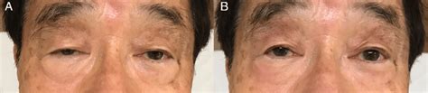 Patient before (A) and after (B) the ice-pack test. (A) The patient had ...