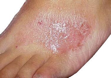 Foot Rash: Causes, Symptoms & Treatment (2023)